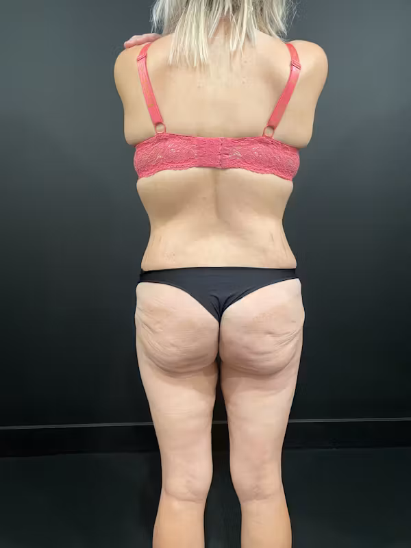 Before Image: Buttock Shaping - back