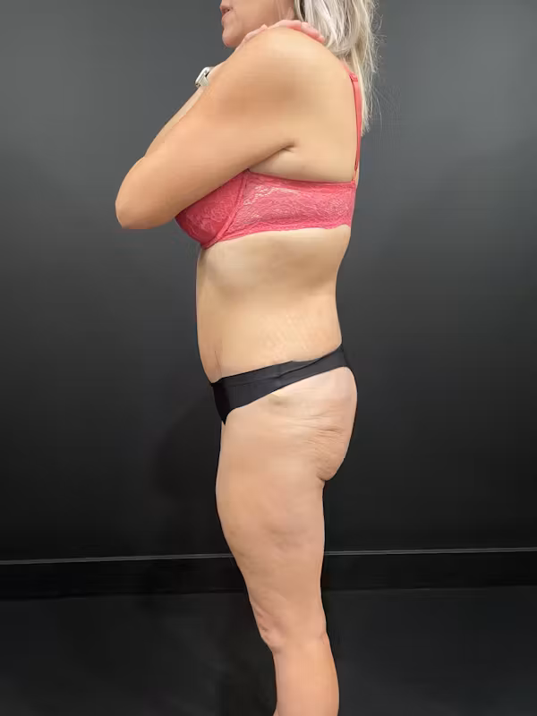 Before Image: Buttock Shaping - left-side