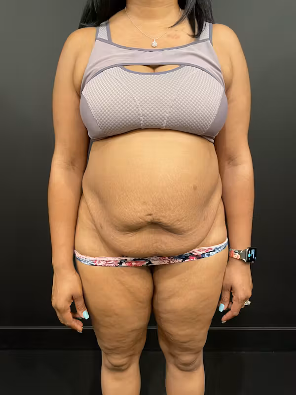 Before Image: Tummy Tuck - front
