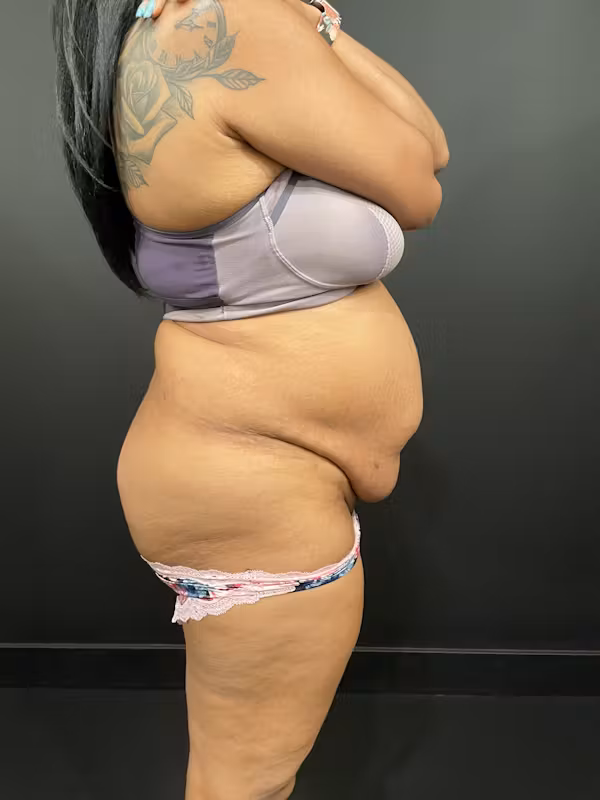 Before Image: Tummy Tuck - right-side