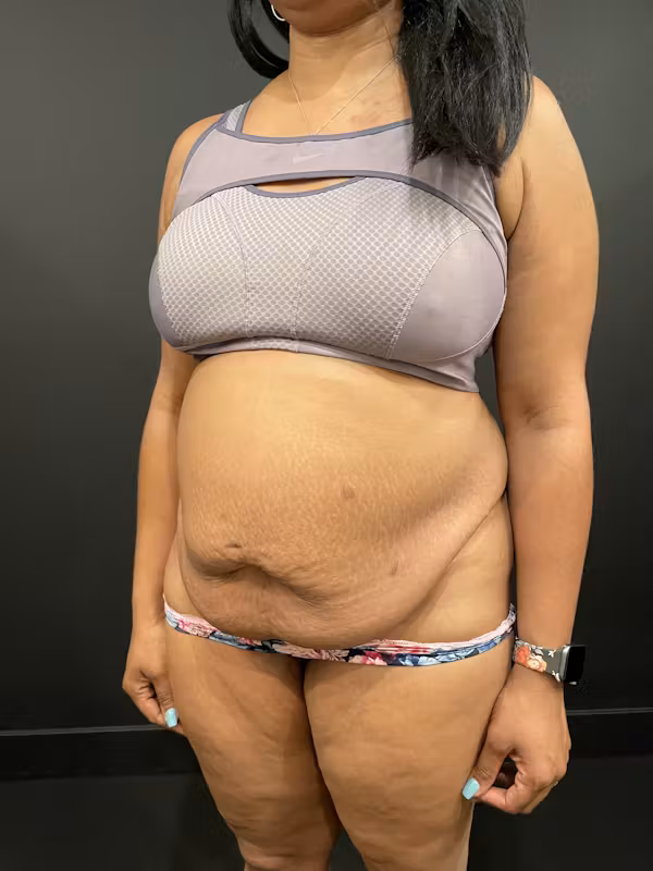 Before Image: Tummy Tuck - left-front-oblique