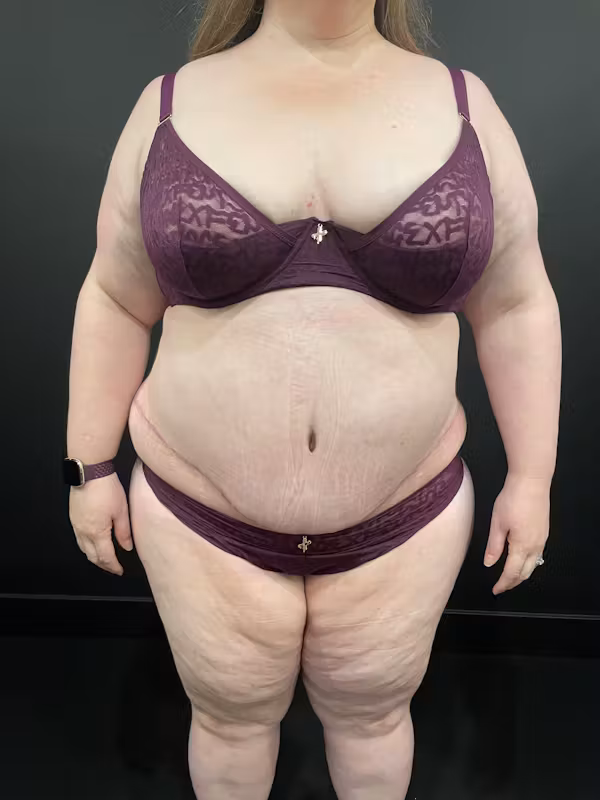 After Image: Plus Size Tummy Tuck - right-front-oblique