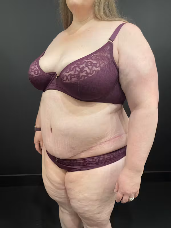 After Image: Plus Size Tummy Tuck - left-front-oblique