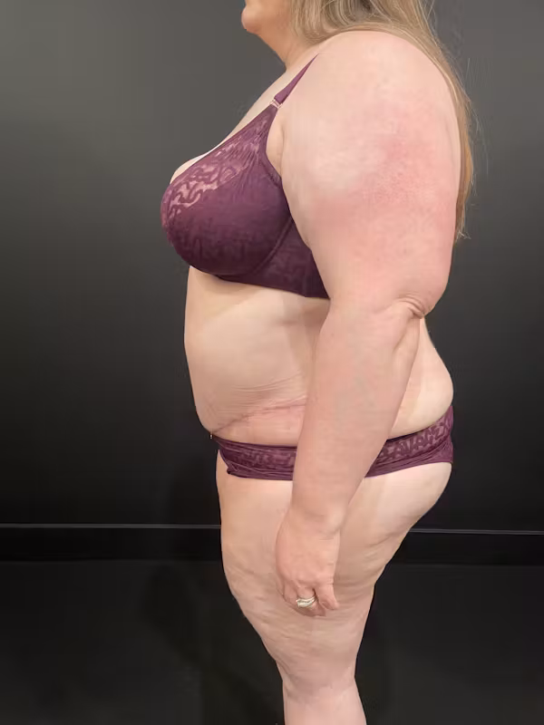 After Image: Plus Size Tummy Tuck - left-side