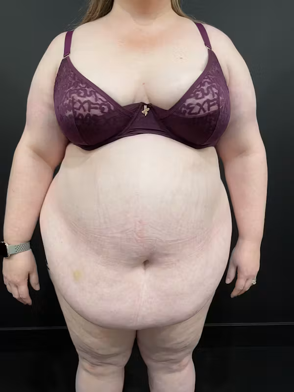 Before Image: Plus Size Tummy Tuck - front