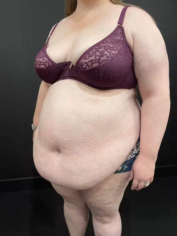 Before Image: Plus Size Tummy Tuck - left-front-oblique