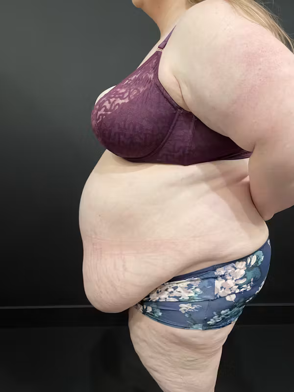 Before Image: Plus Size Tummy Tuck - left-side