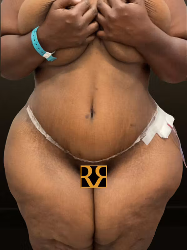 After Image: Plus Size Tummy Tuck - front