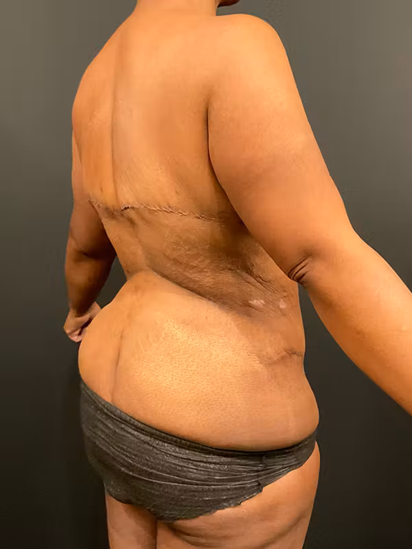After Image: Tummy Tuck - right-back-oblique
