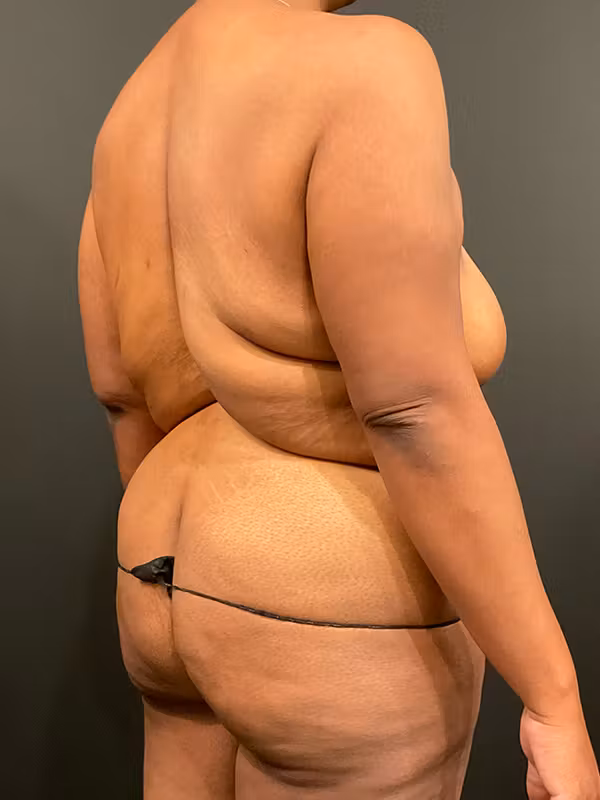 Before Image: Tummy Tuck - right-back-oblique