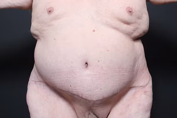 After Image: Male Tummy Tuck - front