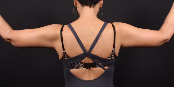 After Image: Arm Lift - back