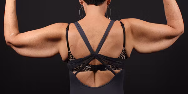 Before Image: Arm Lift - back