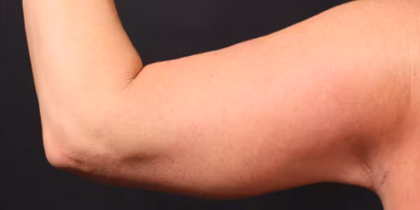 After Image: Arm Lift - back