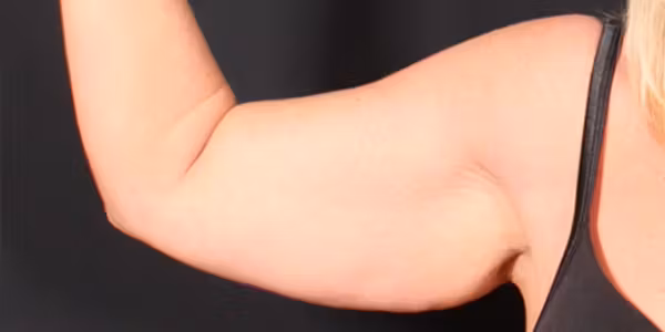 Before Image: Arm Lift - front