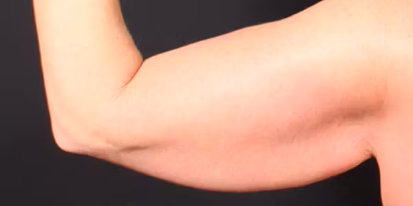 Before Image: Arm Lift - back