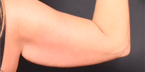 Before Image: Arm Lift - back