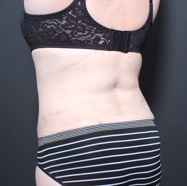 After Image: Mommy Makeover - left-back-oblique