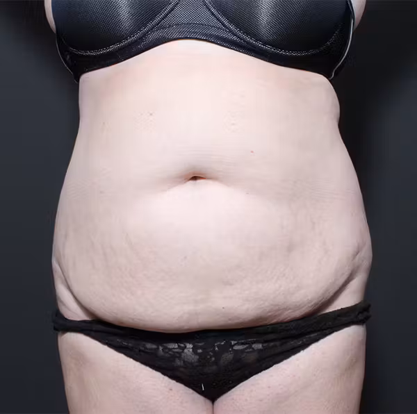 Before Image: Mommy Makeover - front