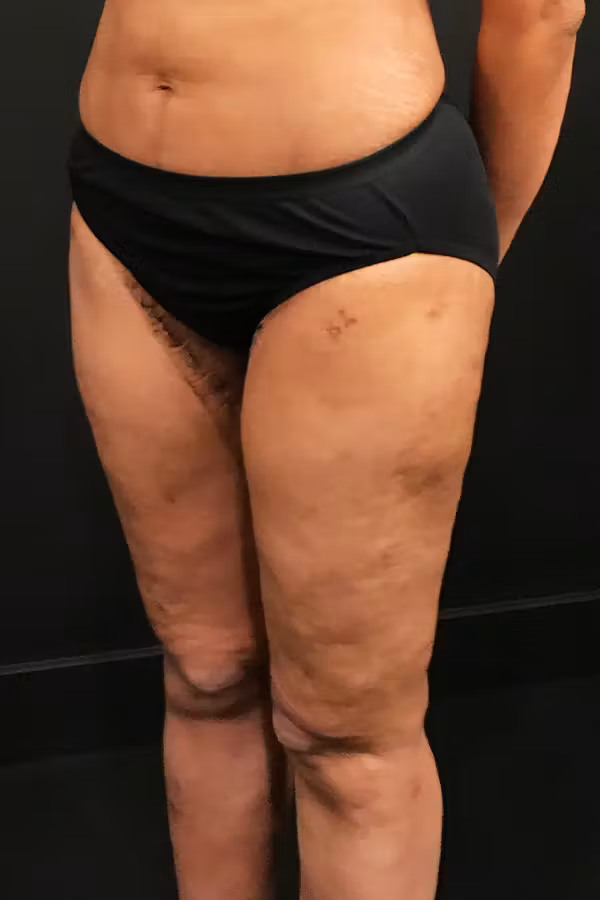 After Image: Thigh Lift - left-front-oblique
