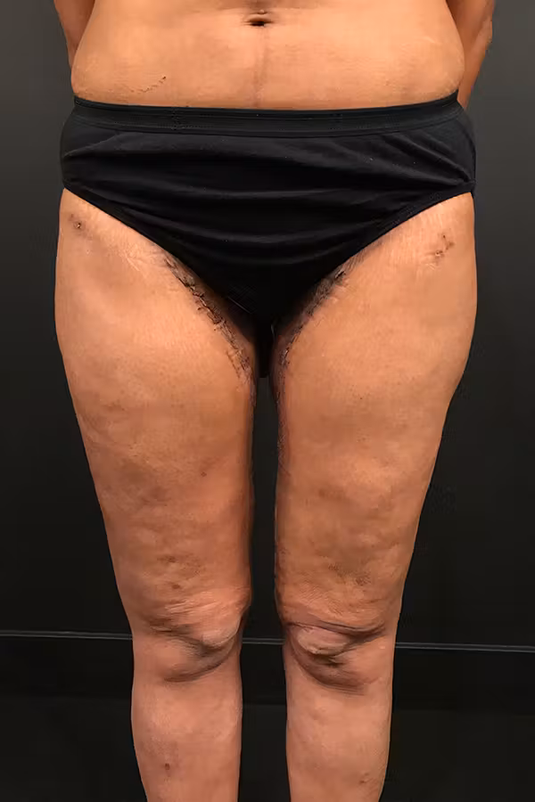 After Image: Thigh Lift - front