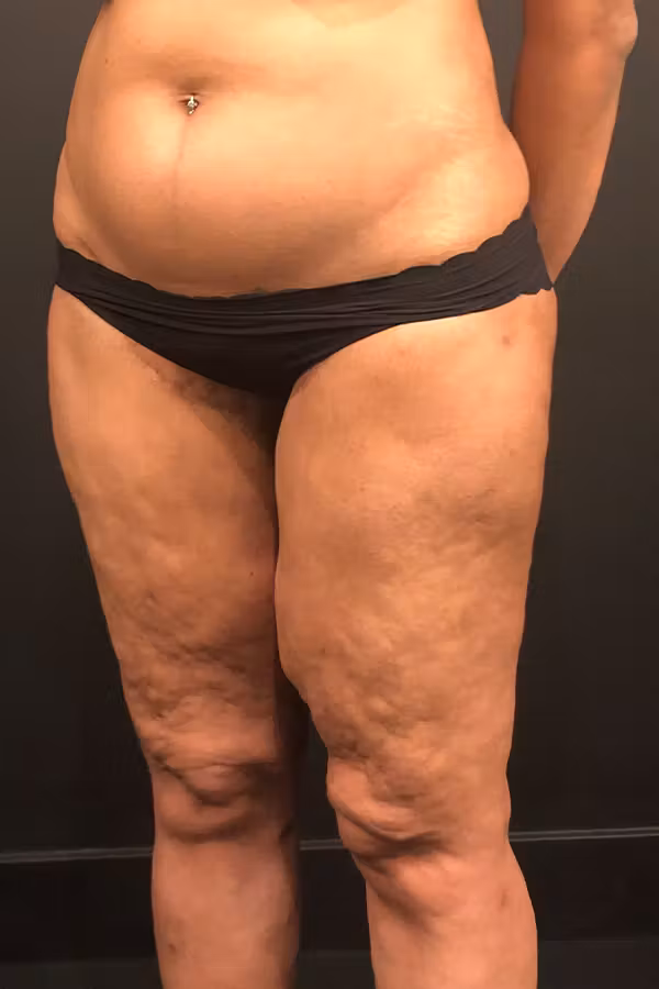 Before Image: Thigh Lift - left-front-oblique