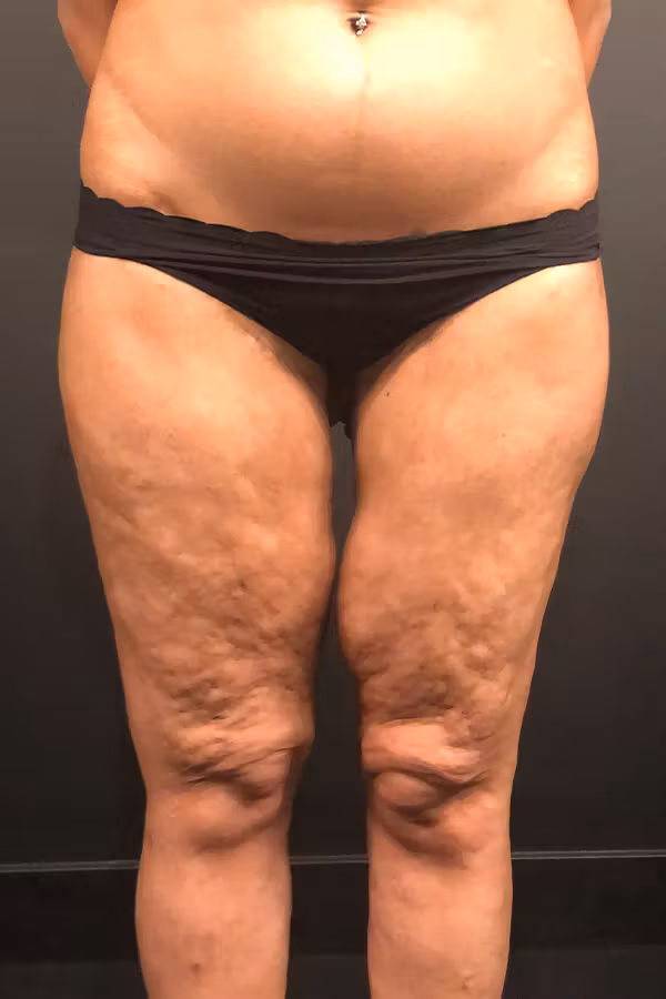 Before Image: Thigh Lift - front