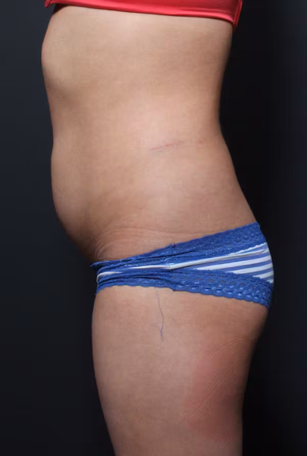 Before Image: Brazilian Butt Lift - left-side