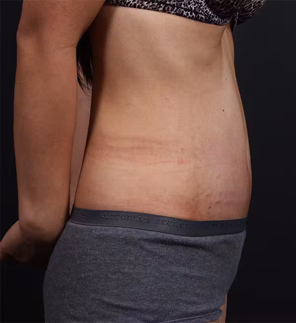 After Image: Hernia Rectus Diastasis Repair - right-side