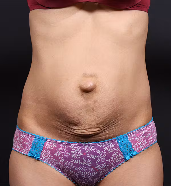 Before Image: Hernia Rectus Diastasis Repair - front