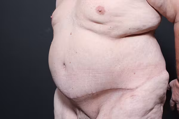 After Image: Hernia Rectus Diastasis Repair - left-front-oblique