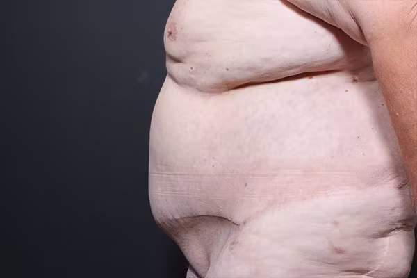 After Image: Hernia Rectus Diastasis Repair - left-side