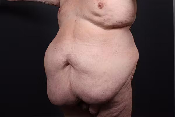 Before Image: Hernia Rectus Diastasis Repair - left-front-oblique