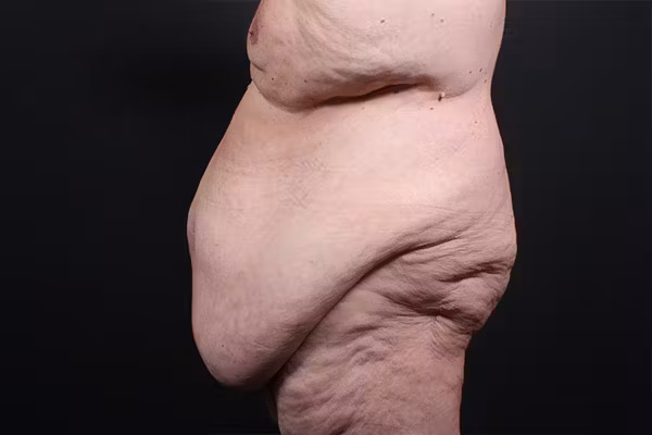 Before Image: Hernia Rectus Diastasis Repair - left-side