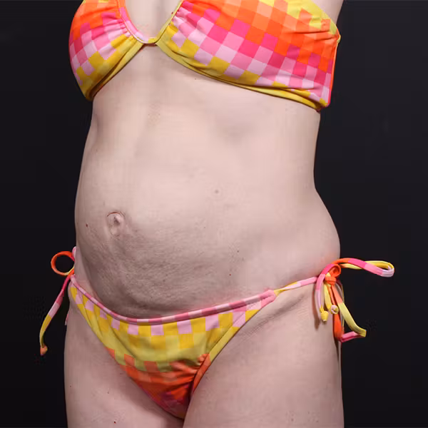 Before Image: Hernia Rectus Diastasis Repair - left-front-oblique