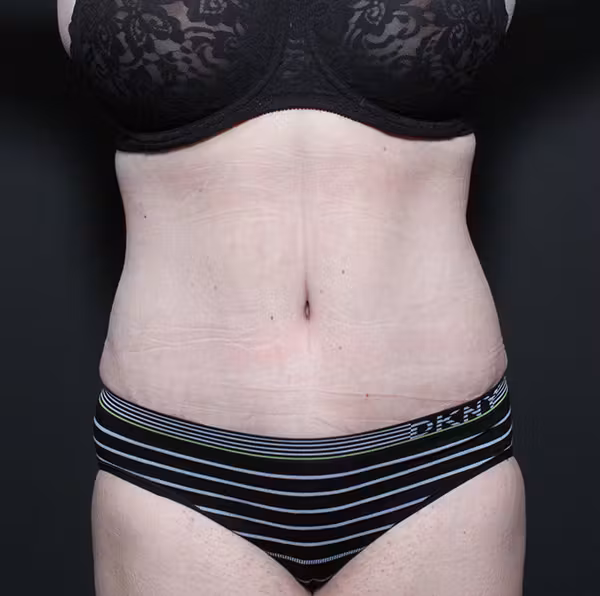 After Image: Liposuction - front
