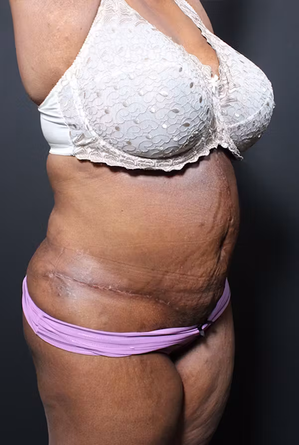 After Image: Plus Size Tummy Tuck - right-front-oblique