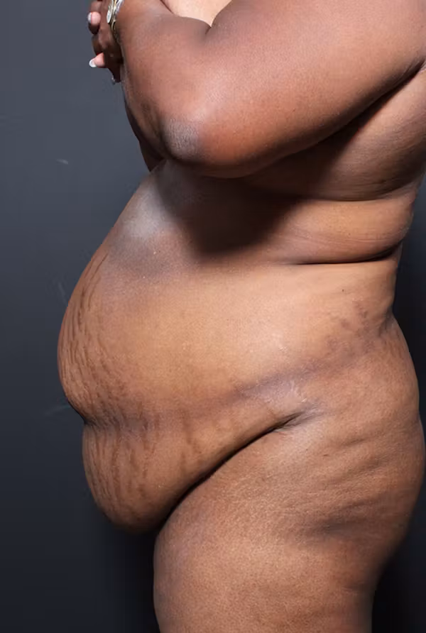 Before Image: Plus Size Tummy Tuck - left-side
