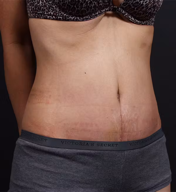 After Image: Liposuction - right-front-oblique