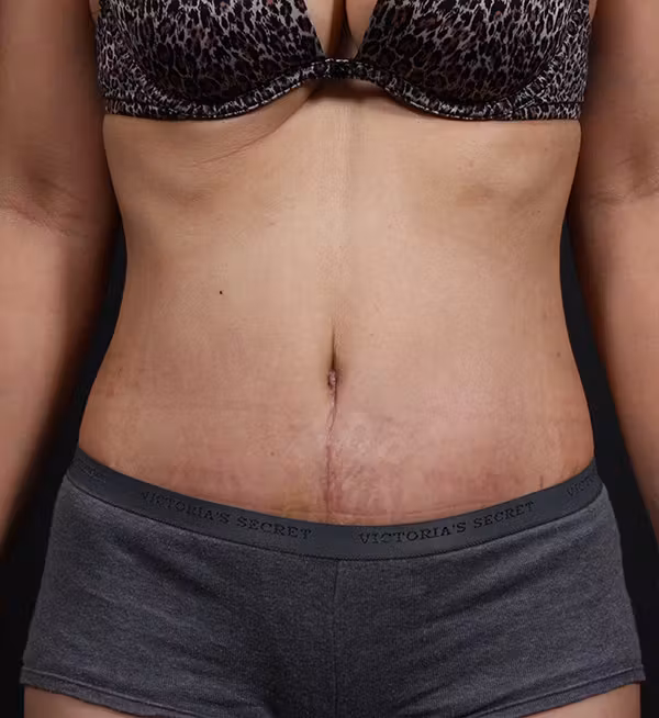 After Image: Liposuction - front