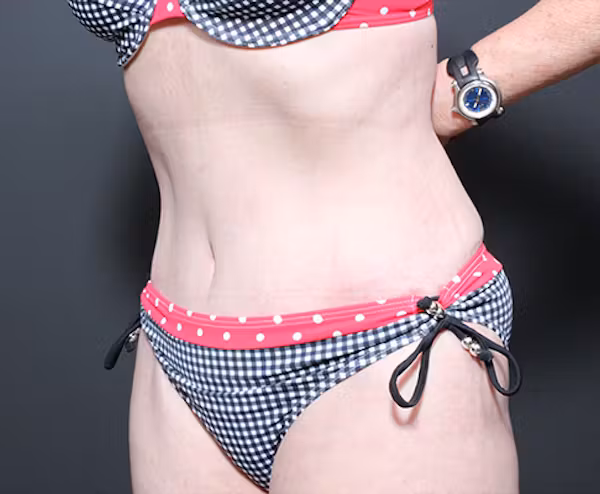 After Image: Liposuction - left-front-oblique