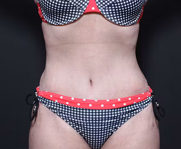 After Image: Liposuction - front