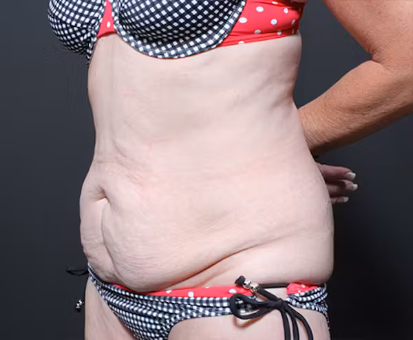 Before Image: Liposuction - left-front-oblique