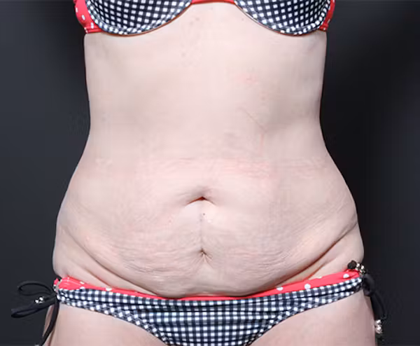 Before Image: Liposuction - front