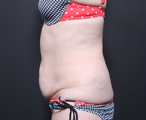 Before Image: Liposuction - left-side
