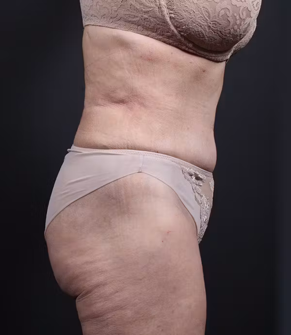 After Image: Liposuction - right-side