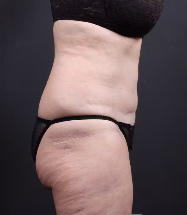 Before Image: Liposuction - right-side