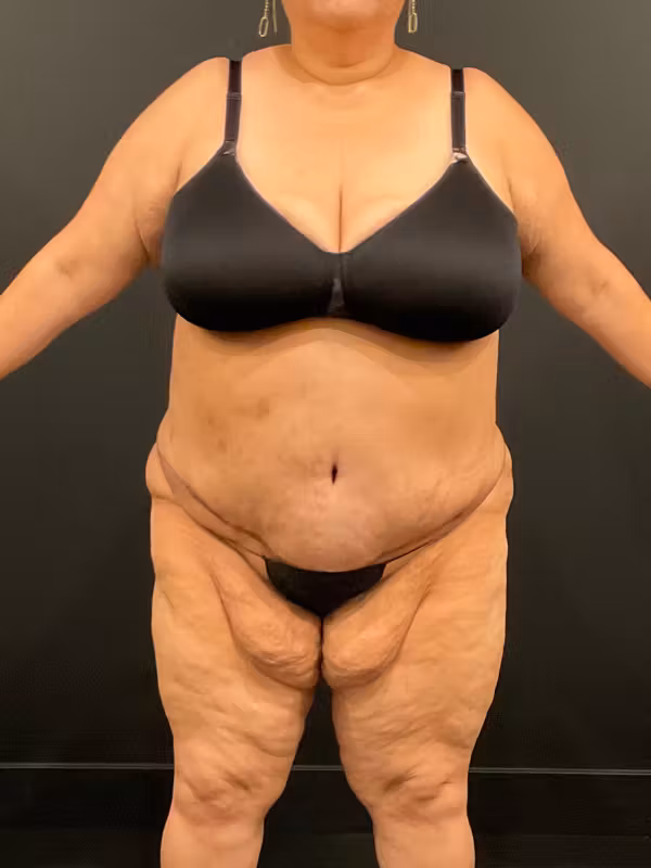 After Image: Plus Size Tummy Tuck - front