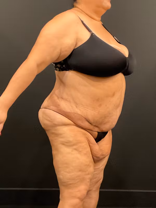 After Image: Plus Size Tummy Tuck - right-front-oblique