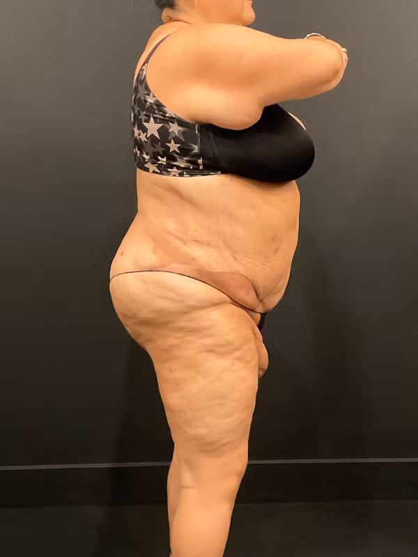 After Image: Plus Size Tummy Tuck - right-side